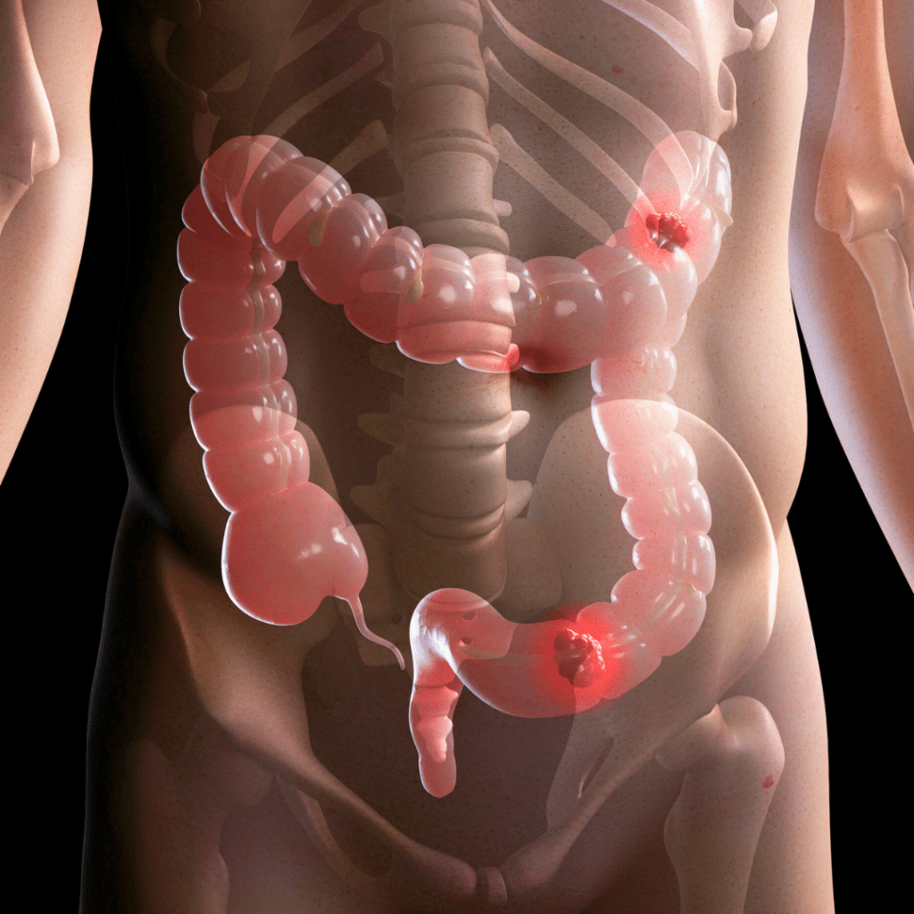 Medicinska ilustracija ljudskog debelog crijeva s prikazom mogućih upalnih procesa i nakupljanja toksina, naglašavajući važnost redovitog čišćenja crijeva i podrške probavi prirodnim vlaknima poput Forever Fiber.