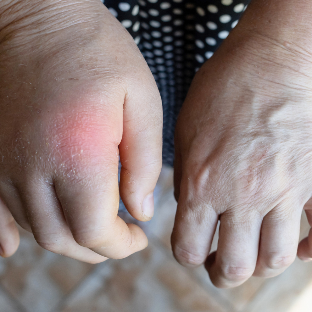 Natečena i upaljena ruka s vidljivim crvenilom kao simptom retencije vode i poremećaja cirkulacije.