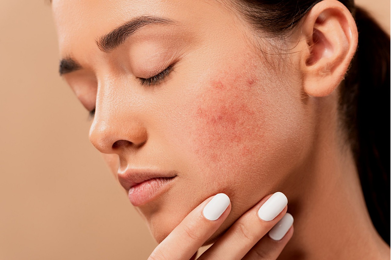acne-5561750_1280