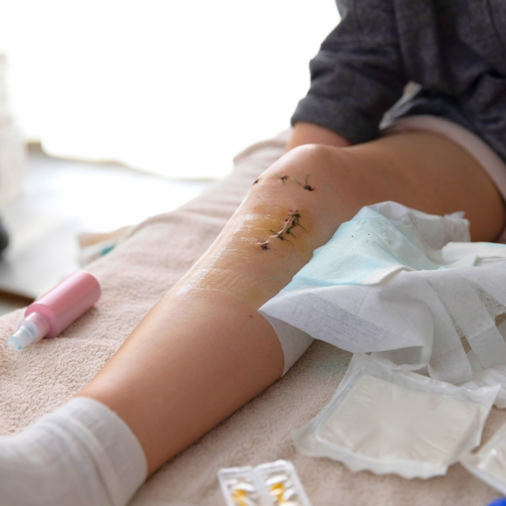 Koljena nakon ACL operacije sa svježim šavovima i laganom oteklinom – početna faza oporavka i njega rane nakon rekonstrukcije prednjeg križnog ligamenta.